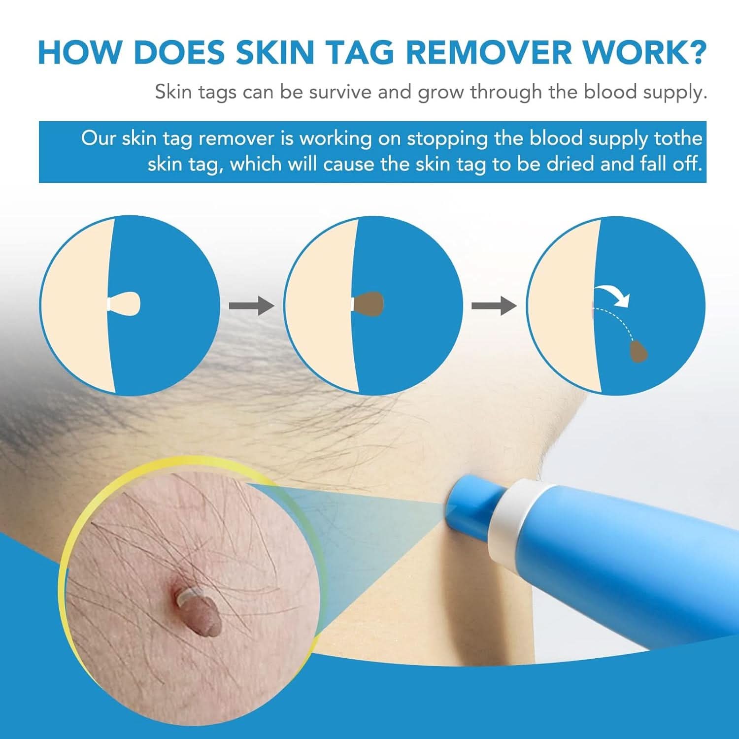 Skin Tag Remover Kit 2 In 1 For Micro To Large (2 Mm - 8 Mm  1 Set)